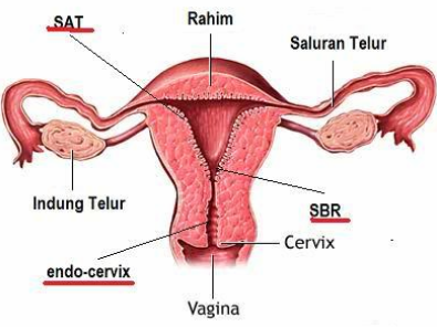 Kanker Serviks Vagina